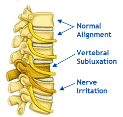 subluxation